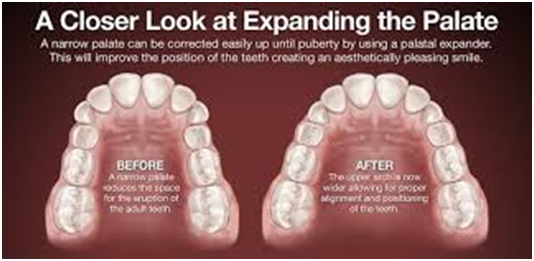 palatal expander diagram