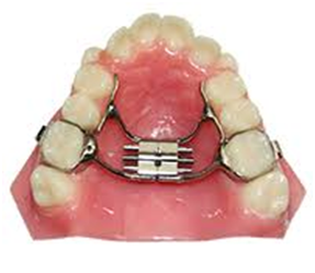 palatal expander